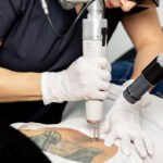 Why Some Choose Tattoo Removal After Divorce for a Fresh Start