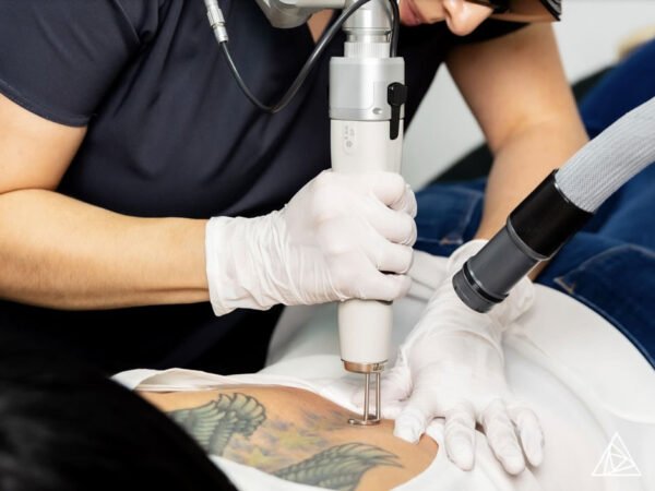 Why Some Choose Tattoo Removal After Divorce for a Fresh Start