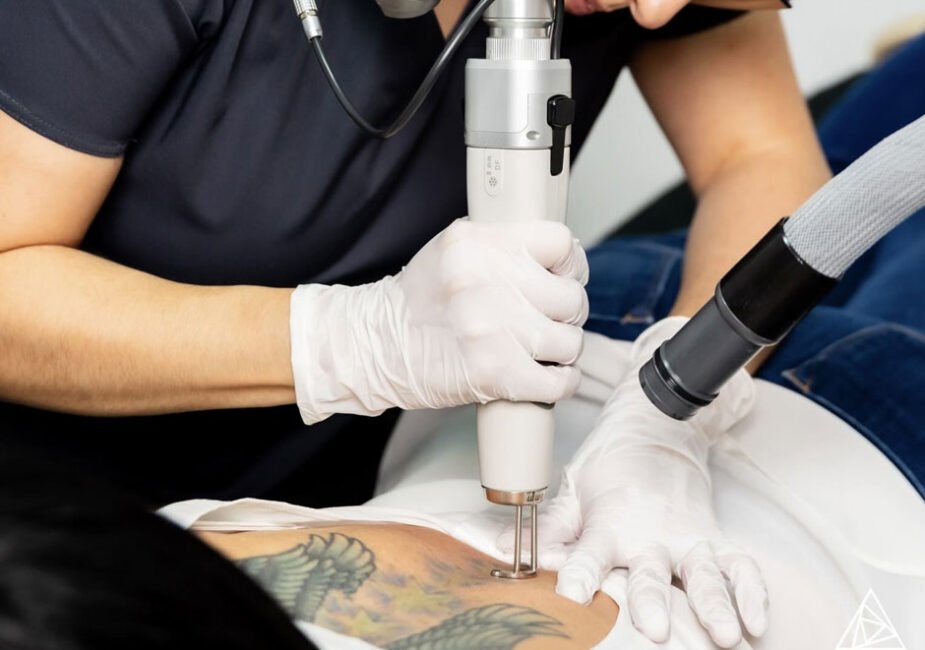 Why Some Choose Tattoo Removal After Divorce for a Fresh Start