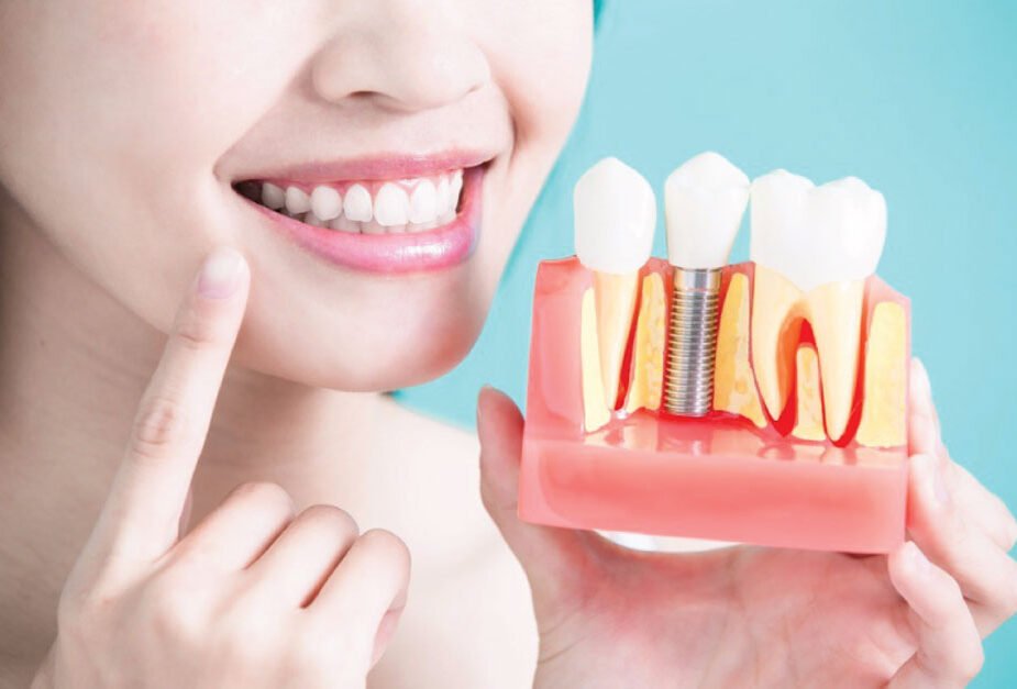 The Lifelong Benefits of Choosing Dental Implants for Tooth Restoration in Winnipeg