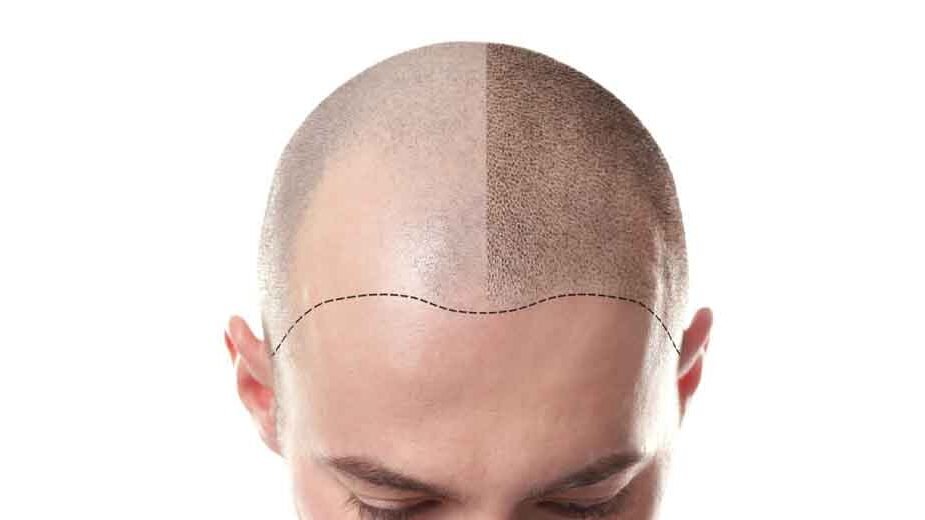 Understanding Scalp Micropigmentation for a Natural Hairline Look