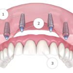 Why More Patients Are Switching to Fixed Implant Bridges