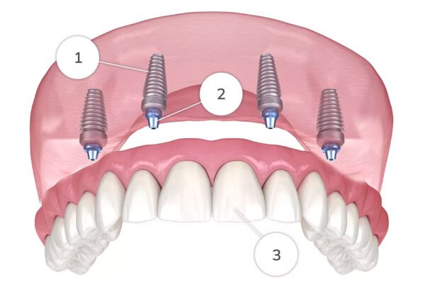 Why More Patients Are Switching to Fixed Implant Bridges
