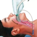 Pre-Procedure Checklist for Safe Supraglottic Airway Device Use