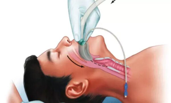 Pre-Procedure Checklist for Safe Supraglottic Airway Device Use