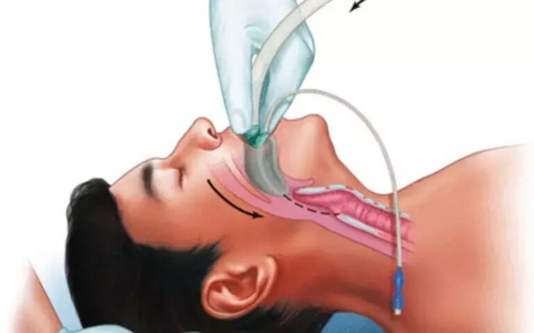 Pre-Procedure Checklist for Safe Supraglottic Airway Device Use