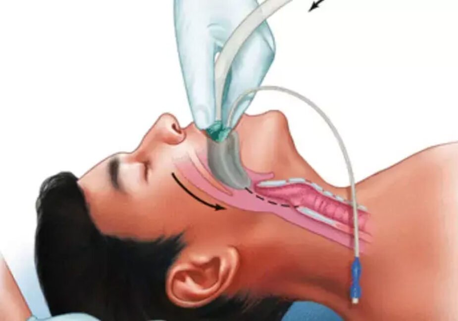 Pre-Procedure Checklist for Safe Supraglottic Airway Device Use