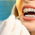 Proven Ways An Orthodontist In Brookhaven Helps With Crowded Teeth