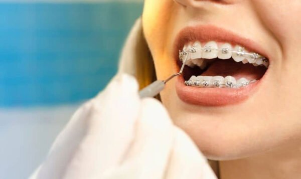 Proven Ways An Orthodontist In Brookhaven Helps With Crowded Teeth