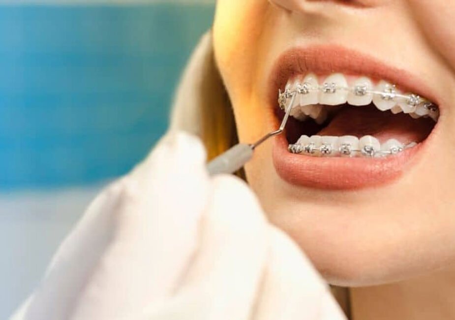 Proven Ways An Orthodontist In Brookhaven Helps With Crowded Teeth