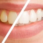Practical Ways to Revitalize a Dull Smile Without Damaging Enamel