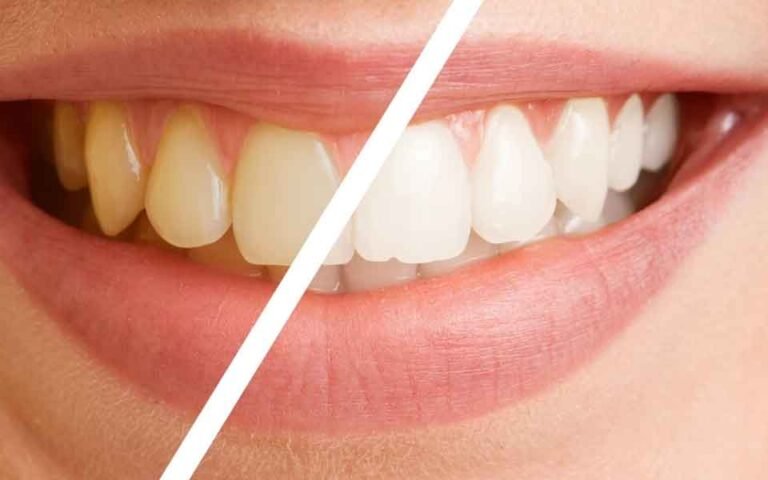 Practical Ways to Revitalize a Dull Smile Without Damaging Enamel