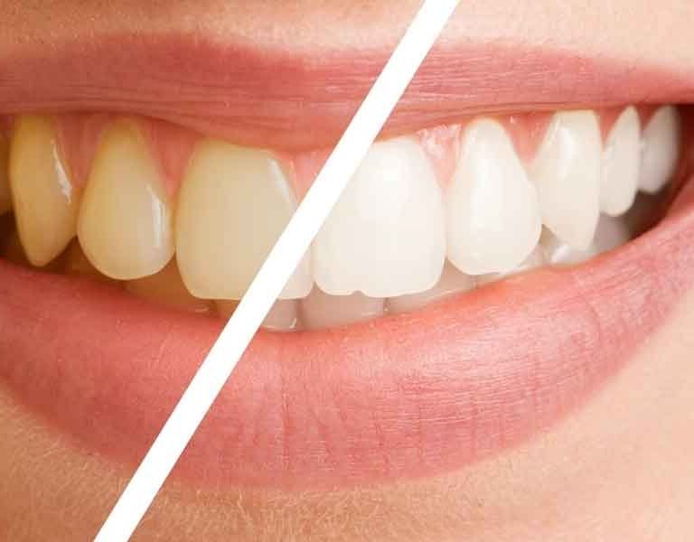 Practical Ways to Revitalize a Dull Smile Without Damaging Enamel