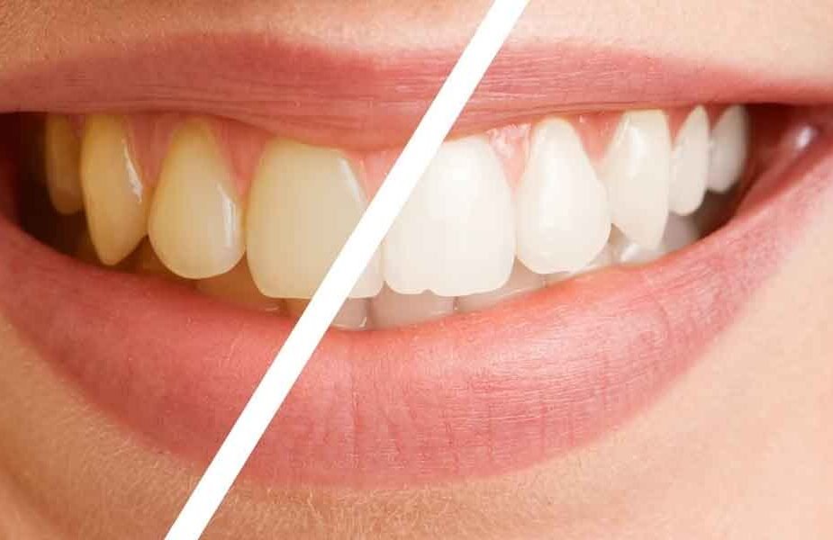 Practical Ways to Revitalize a Dull Smile Without Damaging Enamel